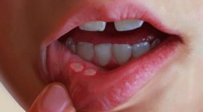 درمان آفت های دهانی با طی سنتی