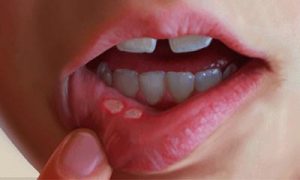  درمان آفت های دهانی با طی سنتی 